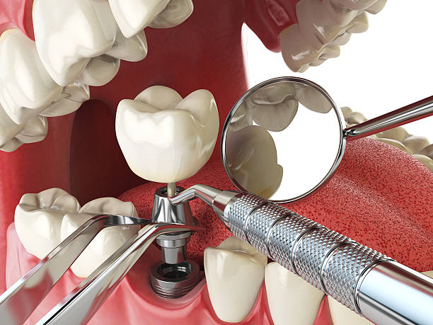 Best Emergency Root Canal Treatment in Duarte, CA